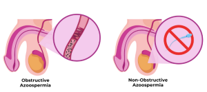 Obstructive Azoospermia / 
Non-Obstructive Azoospermia