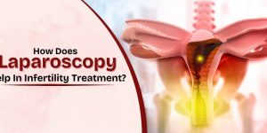 Laparoscopy Treatment